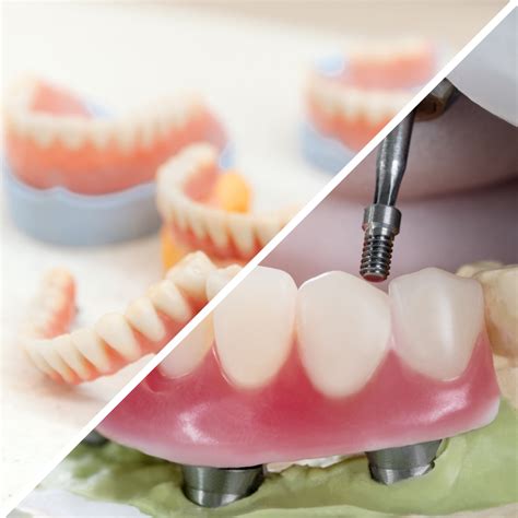 dental implants yuba city